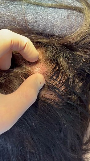 Scalp Atheroma Removal - What You Need to Know