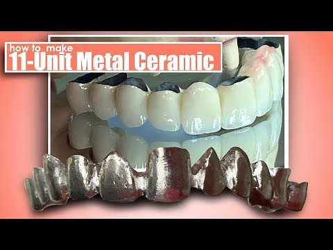 How to Make an 11-Unit Metal Ceramic Restoration
