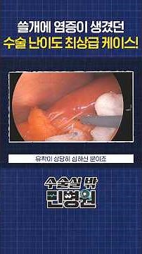 A Real-Life Case of High-Difficulty Gallbladder Surgery for Chronic Cholecystitis🔎