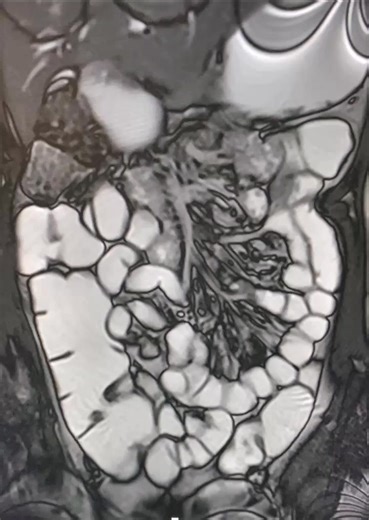 8.3K views · 91 reactions | Dynamic mri enterogrphy | Radiology - 1895 | Facebook