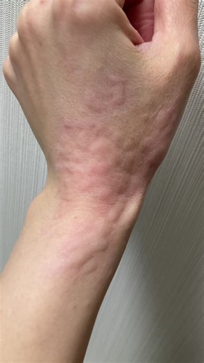 手に蕁麻疹ができて激痒な経験
