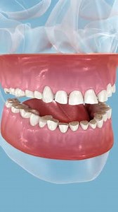 Dental attrition (Bruxism) resulting in loss of tooth tissue. Dental 3D animation