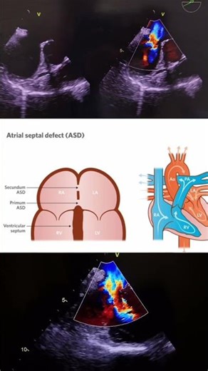 Secundum ASD( Left to right shunt), deficient aortic rim, floppy IVC rim. #echocardiography