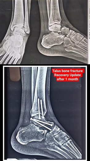 किशन जी के talus bone fracture आप्रेशन के 1 महीने बाद रिकवरी अपडेट #fracturerecovery #bonefracture