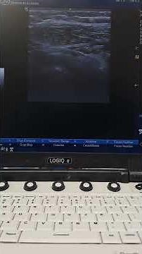 Combined PENG & SHAC Block for frozen shoulder (Adhesive Capsulitis)