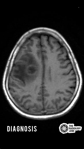 Diagnosis⬇️ #NeuroImaging #RadiologyCases #MedicalImaging #TheRadiologyLens | The Radiology Lens