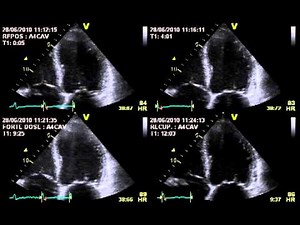 TRUE SEVERE AORTIC STENOSIS / STRESS ECHOCARDIOGRAPHY cardiac ultrasound