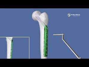 Double Medical Dynamic Hip Screw System