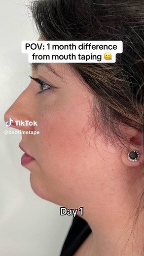 Mouth Taping Results: Before and After Transformations Revealed