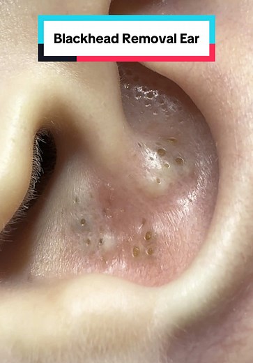 Effective Blackhead Removal Treatment for Clear Skin