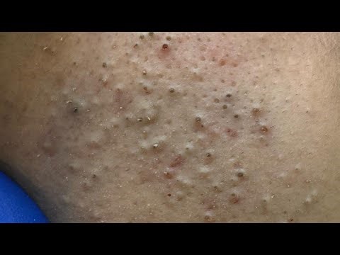 ASMR Relaxing Blackhead & Pimple Extraction - Deep Cleansing for Glowing Skin