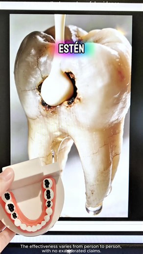 #caries #toothache | tooth