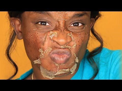 CHEMICAL PEEL Full Process | Procedure | Peeling | Before & After