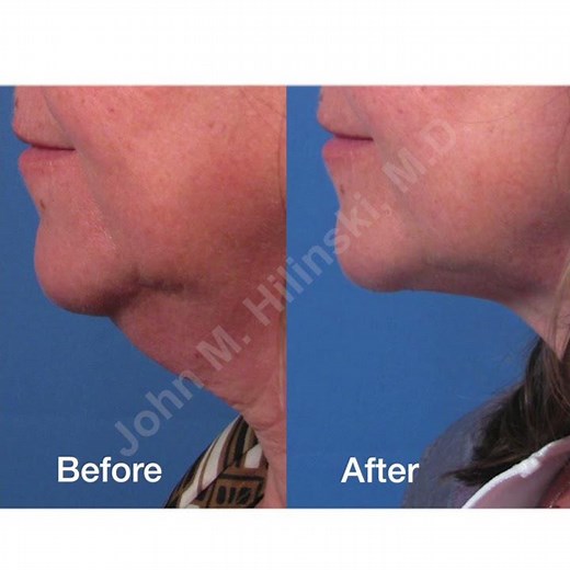 Double Chin Correction aka "Platysmaplasty"