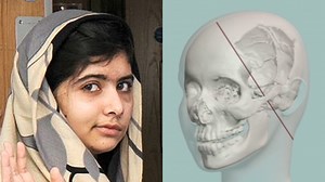 How doctors will repair Malala Yousafzai’s skull