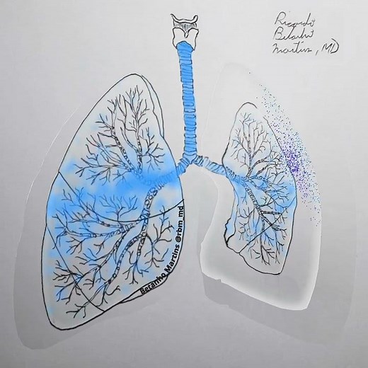 Pneumothorax Pathophysiology shown in 30 seconds