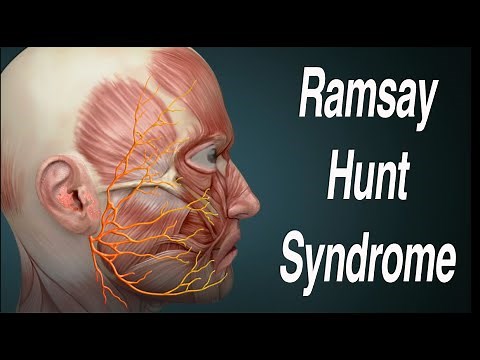 Ramsay Hunt Syndrome