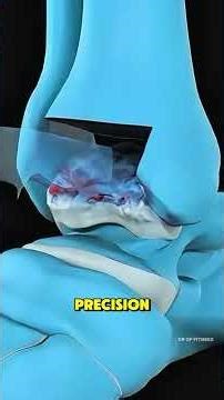 How Ankle Joint Replacement (3D Animation)