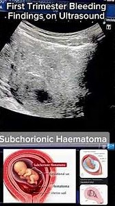1st trimester bleeding. subchorionic hematoma - obstetrical ultrasound #ultrasound ⁨@Dr.Saimakhan⁩