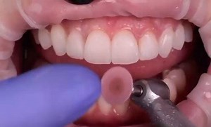 Polishing temporary veneers  . . . Flowable injection technique done by @enrique_diazguzman | Dentistry blog | Facebook