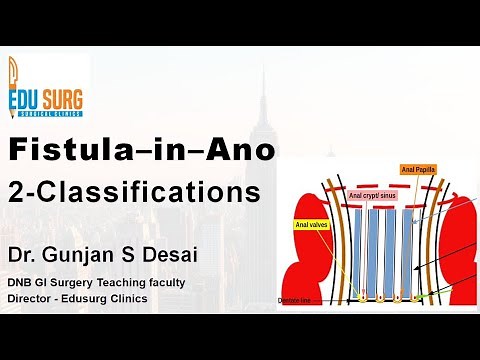 Fistula in Ano: Parks Classification, High vs Low, Simple vs Complex & MRI Grading (St. James)