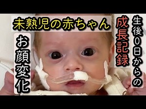 From Birth at 500g to Her Changing Face: A Premature Baby's 5-Month Growth Record