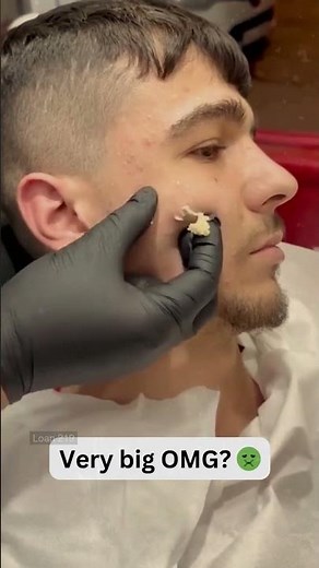 Large Blackheads Extraction Big Cystic Acne Blackheads&Whiteheads Removal Pimple Popping #1106 2026