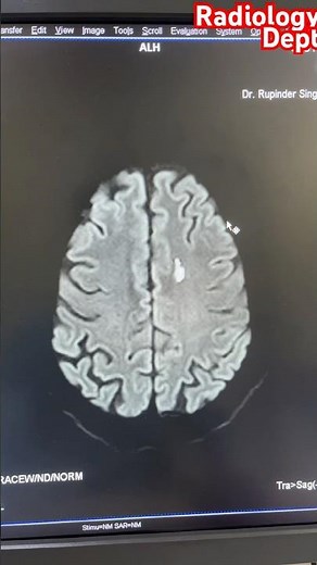 Acute Infarction left Cerebral @radiologydept