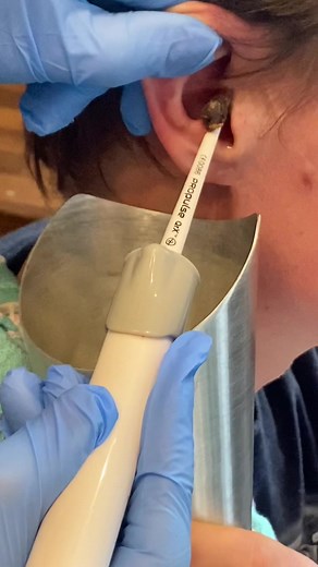 Effective Ear Wax Removal Techniques