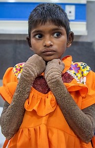 A nine-year-old girl was born with a very rare condition that causes extreme stone-like blisters to form all over her body | Born Different