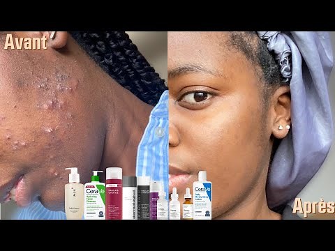L'acné sur peau noire I Comment elle a sauvé sa peau en 2 mois avec 10 étapes simples - Partie 1