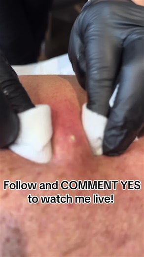 #CapCut sebaceous cyst removal #cyst #sebaceouscystremoval #blemishremoval #skintagremoval #yokehillwellbeing