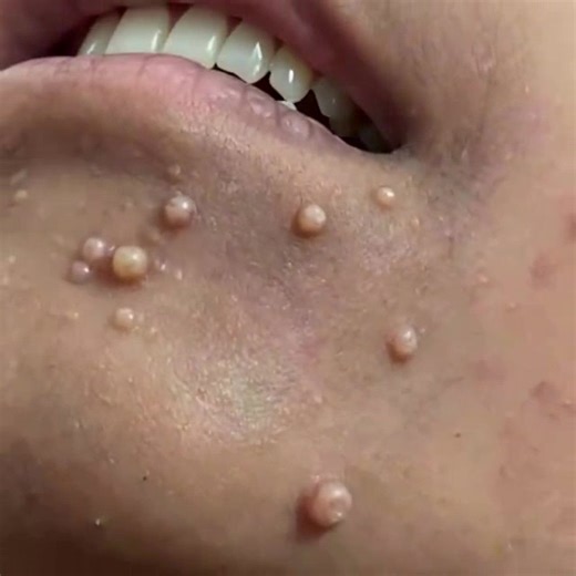 13K views | Tout ce que vous devez savoir sur le molluscum contagiosum… Voir plus | Aimer Tant que Possible | Facebook