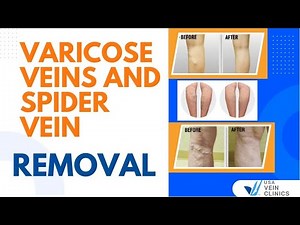 Varicose Veins and Spider Vein Removal | USA Vein Clinics