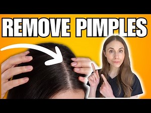 How To Remove Scalp Pimples | Folliculitis Explained
