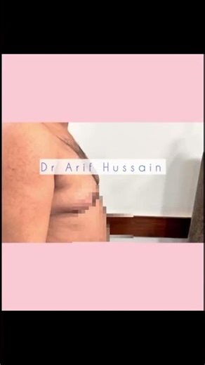 Gynecomastia Recovery Day 2: Male Chest Reduction + Comfort Tips #cosmeticsurgery