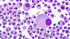 Mayo Clinic Q&A podcast: Advances in treating multiple myeloma help extend quality of life for patients - Mayo Clinic News Network