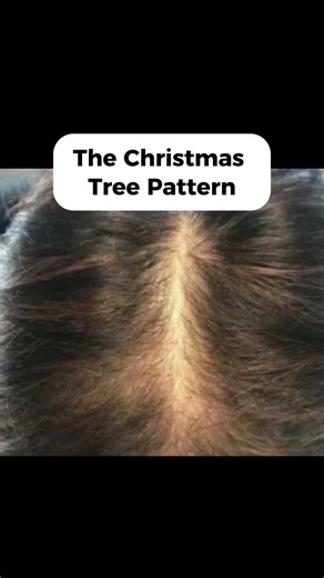 DHT Hair Loss Signs Most People Ignore (Early Warning Patterns)
