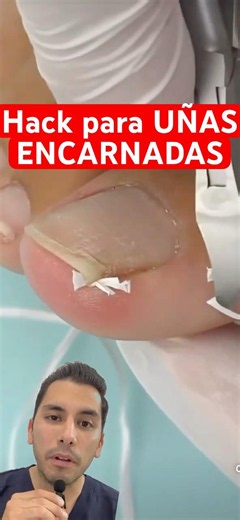 Ingrown toenail? Use dental floss. #podiatry #tips #hack #ingrowntoenails #nails #podiatry