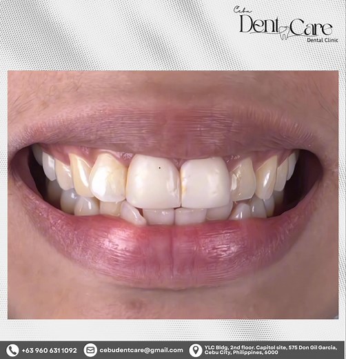 This incredible transformation was achieved with Direct Veneers—no waiting, no hassle, just a gorgeous, natural-looking result! Direct veneers use a special composite material expertly bonded right onto your teeth. It’s perfect for fixing small chips, gaps, or discolorations. The best part? It's fast and gentle on your natural tooth structure. Contact Us: 📩 Message us 📲 63 960 631 1092 📍 YLC Bldg, 2nd floor. Capitol site, 575 Don Gil Garcia, Cebu City, Philippines, 6000 - - - - #CebuDentCare 