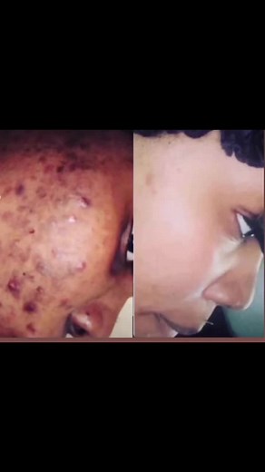 Filters are great but great skin is better 💁🏻‍♀️ Get you Clear Suit today 🥳 Ask about our packages 💗 #fypシ #fyp #viral #trending #trini_tiktoks #trinidad🇹🇹