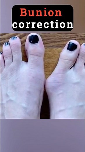 Bunion Correction Exercise – Fix Your Big Toe Naturally