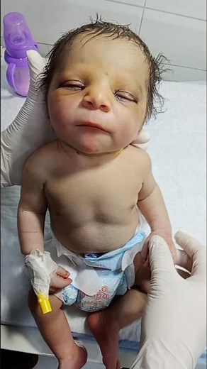 Neonatal Jaundice Management in NICU | Treatment Care and Supportive Monitoring
