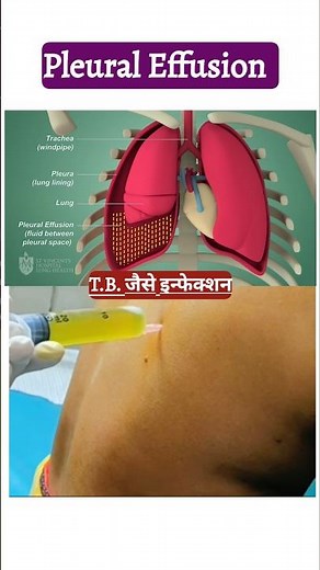 Pleural Tapping
