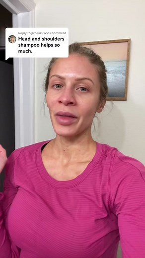 Pityriasis Rosea Skin Rash Treatment with Head and Shoulders