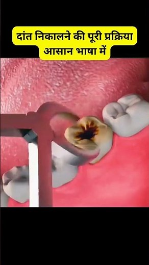 Tooth Extraction – Step by Step Guide