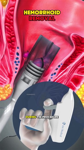 Understanding Hemorrhoid Removal with Rubber Band Ligation