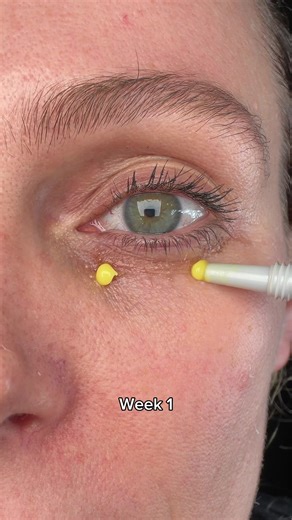 Achieve Tighter, Smoother Skin with Retinal Shot