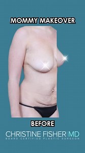 Before & After: Mommy Makeover