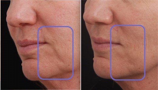 Intensif Microneedling Treatment | Visage Dermatology